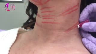 آموزش جوانسازی با نخ روی گردن