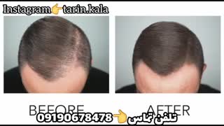 اسپری پرپشت کننده موی سر 09190678478  درمان کم پشتی موی سر
