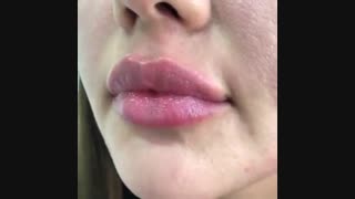 تزریق ژل لب طبیعی