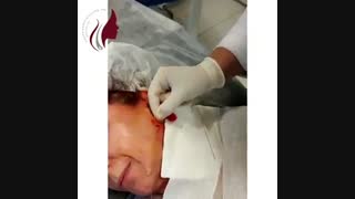 فیلم واقعی لیفت صورت با نخ - پارت دوم