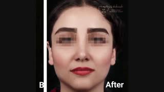 رینوپلاستی و تغییرات بعد از عمل