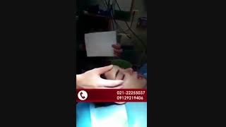 لیفت اندوسکوپی پیشانی برداشتن خال گوشتی