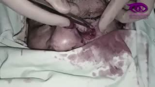 فیلم واقعی جراحی سرطان سلول بازال سل