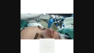 جراحی ترمیمی بینی همزمان با تزریق چربی صورت جهت زاویه سازی لمینت