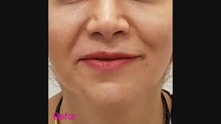 فیلم نتیجه بسیار عالی هایفوتراپی