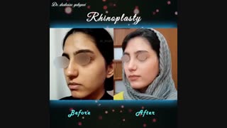 فیلم قبل و بعد از جراحی بینی