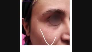 فیلم واقعی از قبل و بعد تزریق فیلر زیر چشم