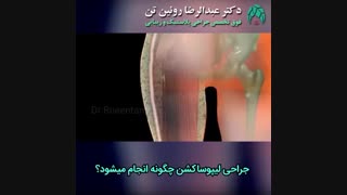 جراحی لیپوساکشن چگونه انجام می شود؟