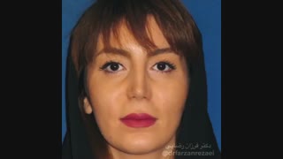 جراحی بینی و تزریق چربی به گونه و فک آر اف فرکشنال