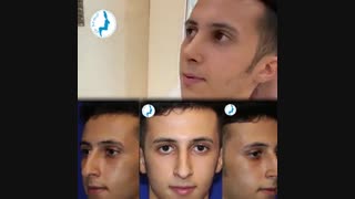 رضایت بیمار چهل و یک روز بعد از جراحی بینی
