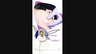 همه چیز درباره اندولیفت