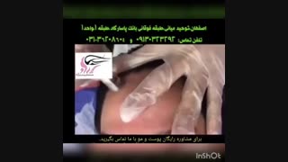 هایفوتراپی برداشتن توده