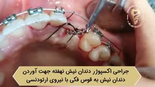 فیلم واقعی جراحی اکسپوژر دندان