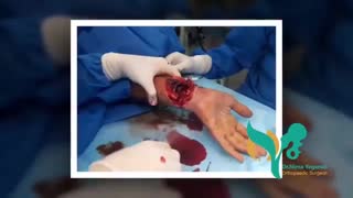 فیلم واقعی جراحی تاندون هاى دست