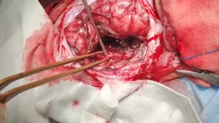 بچه یک ساله با شکایت تشنج تحت عمل جراحی تومور بزرگ مغزی قرار گرفتند