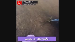 تخلیه موی زیر پوستی