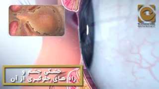 خشکی چشم و راه های درمان آن