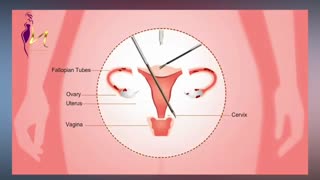 فیلم واقعی هیسترکتومی (خارج کردن رحم) با حفظ تخمدان‌ها