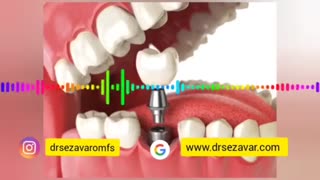 طول عمر ایمپلنت چند سال است