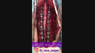 درمان تنگی کانال کمری