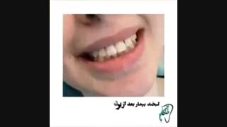 برداشت کامپوزیت ونیر رفع غبغب