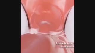 ایمپلنت دندان