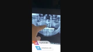 تقویت استخوان و کاشت 8 واحد ایمپلنت توسط دکتر شهرام اسعدی بررسی لک صورت