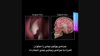 فیلم جراحی پولیپ بینی