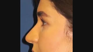 جراحی بینی بدون تامپون