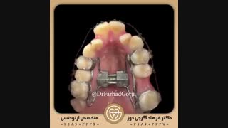 بیمار ۲۱ ساله با مشکل تنگی کام فک بالا | دکتر فرهاد گرجی دوز