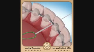 مراحل تمیز نگه داشتن ریتینرهای ثابت به این ترتیب است (درکپشن بخوانید) | دکتر فرهاد گرجی دوز