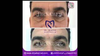 تزریق فیلر زیر چشم و جالوپرو