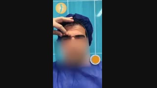 جراحی لیفت اندوسکوپیک ابرو