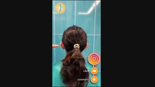 جراحی گوش برجسته (اتوپلاستی)