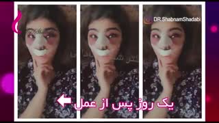 مقایسه نتیجه عمل بینی قبل و بعد از عمل