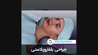 جراحی بلفاروپلاستی