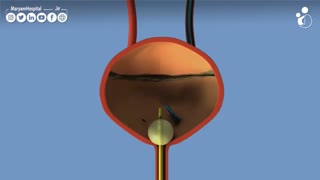 عمل شکستن سنگ کلیه