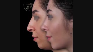 تغییرات بعد از عمل بینی