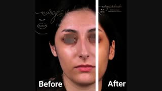 فیلم جالب از میزان تغییرات بعد از عمل بینی