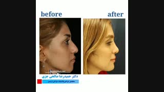 نمونه بینی نیمه فانتزی ۱۹ روز بعد از عمل