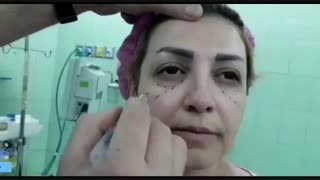 معرفی نقاط چربی در صورت