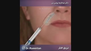 تزریق فیلر | فوق تخصص جراحی پلاستیک | دکتر عبدالرضا روئین تن