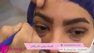 بلفاروپلاستی Blepharoplasty چیست؟ مزایا,مراقبتها