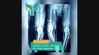 فیلم جراحی واقعی تعویض مفصل زانو