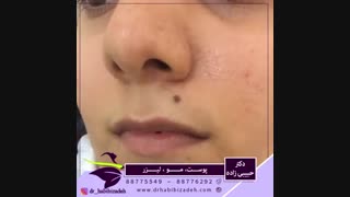 فیلم برداشتن خال گوشتی ریشه دار