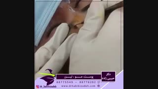 فیلم برداشتن خال با جراحی