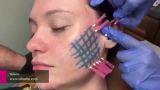 جاگذاری نخ PDO برای رفع اسکار آکنه