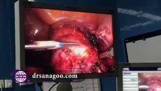 خارج کردن رحم و تخمدان به روش لاپاروسکوپی