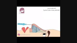 لیفت بینی با نخ