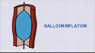 فیلم آنژیوگرافی از طریق دست و پا